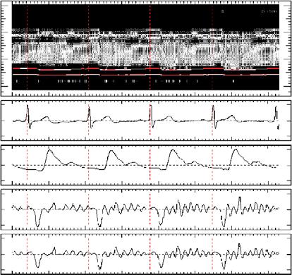 H. Kanai et al. / International Congress Series 1274 (2004) 64 74 73 Fig. 7. (a) (1) M-mode image. (2) Electrocardiogram. (3) Blood pressure. (4) Velocity at intimal side.