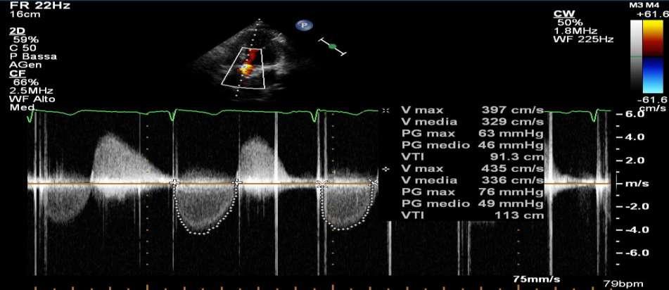 Transthoracic Doppler echocardiography Severe aortic prosthesis regurgitation due to incomplete leaflet apposition, with a significantly increased