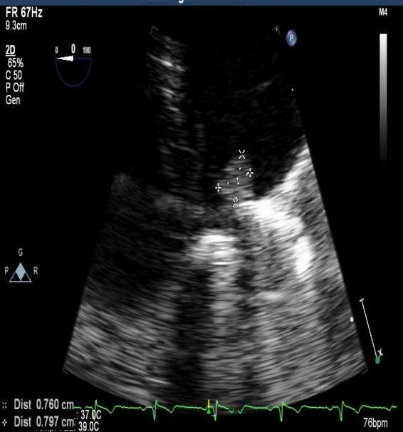 Transoesophageal echocardiography Revealed a thrombus (about 8 x 6 mm) located between the two prostheses, causing intermittent aortic valve