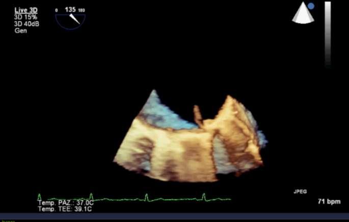 3 days later Transoesophageal echocardiogram revealed: a decreased aortic transvalvular
