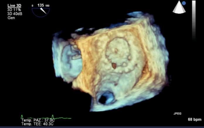 adhering to the mitral prosthesis and fluctuating through the prosthetic valve.