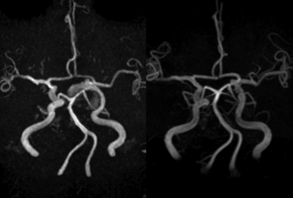 Endovascular Embolization of Large Internal Carotid Ar tery Aneurysms Especially for the Aneurysms with Indication for Pipeline Fig. 2 Left: preoperative MRA, right: MRA 52 months postoperative.