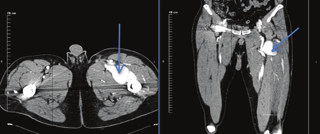 2 Case Reports in Vascular Medicine Figure 1: CT angiogram showing the left profunda femoris artery pseudoaneurysm. (a) (b) Figure 2: 3D reconstruction of left profunda femoris artery pseudoaneurysm.