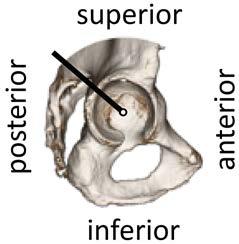 Posterior-Superior Cartilage Example PD-Weighted