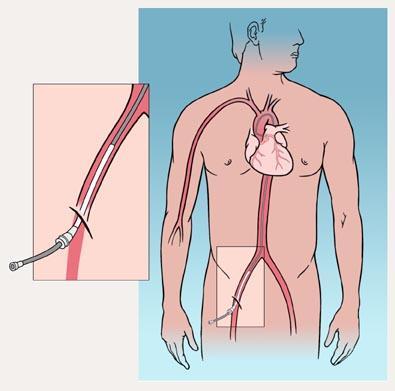 Medical Procedures and Surgery You may need a procedure or surgery to treat coronary heart disease. Both PCI and CABG are used to treat blocked coronary arteries.