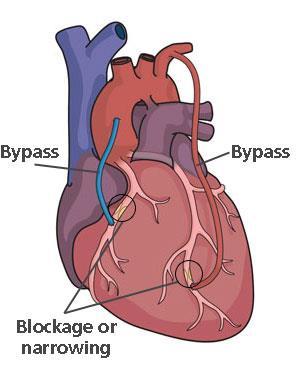 Coronary Artery Bypass Grafting CABG is a type of surgery in which arteries or veins from other areas in your body are used to bypass (that is, go around) your narrowed coronary arteries.