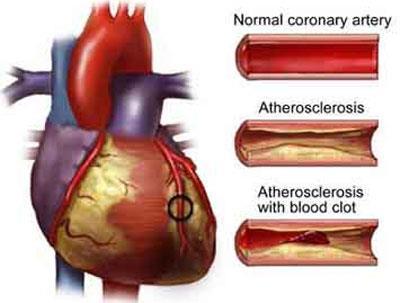 Atherosclerosis Over time, plaque can harden or rupture (break open). Hardened plaque narrows the coronary arteries and reduces the flow of oxygen-rich blood to the heart.