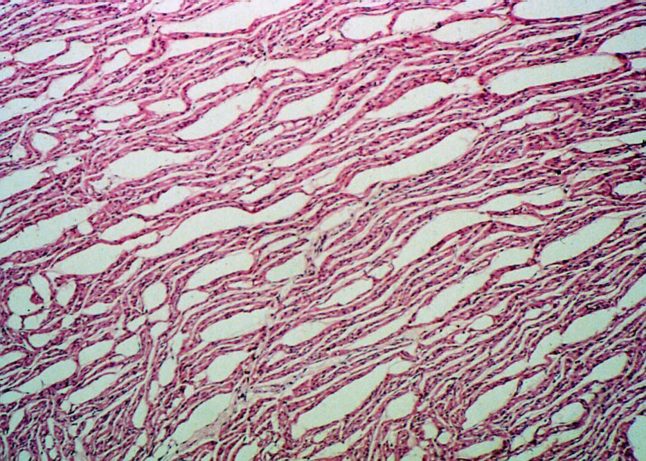 Case 9 Photomicrograph of heart from a young calf which died to E coli enteritis. What do you think these changes represent? Freezing artifacts!