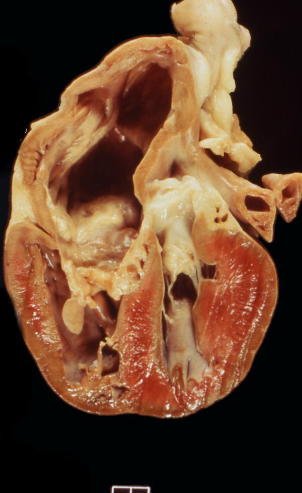 Case 1 Heart - Echoplane section from a 7-month-old Labrador retriever Give two morphologic diagnoses 1. Tricuspid dysplasia (severe) 2. Right ventricular hypertrophy 3.
