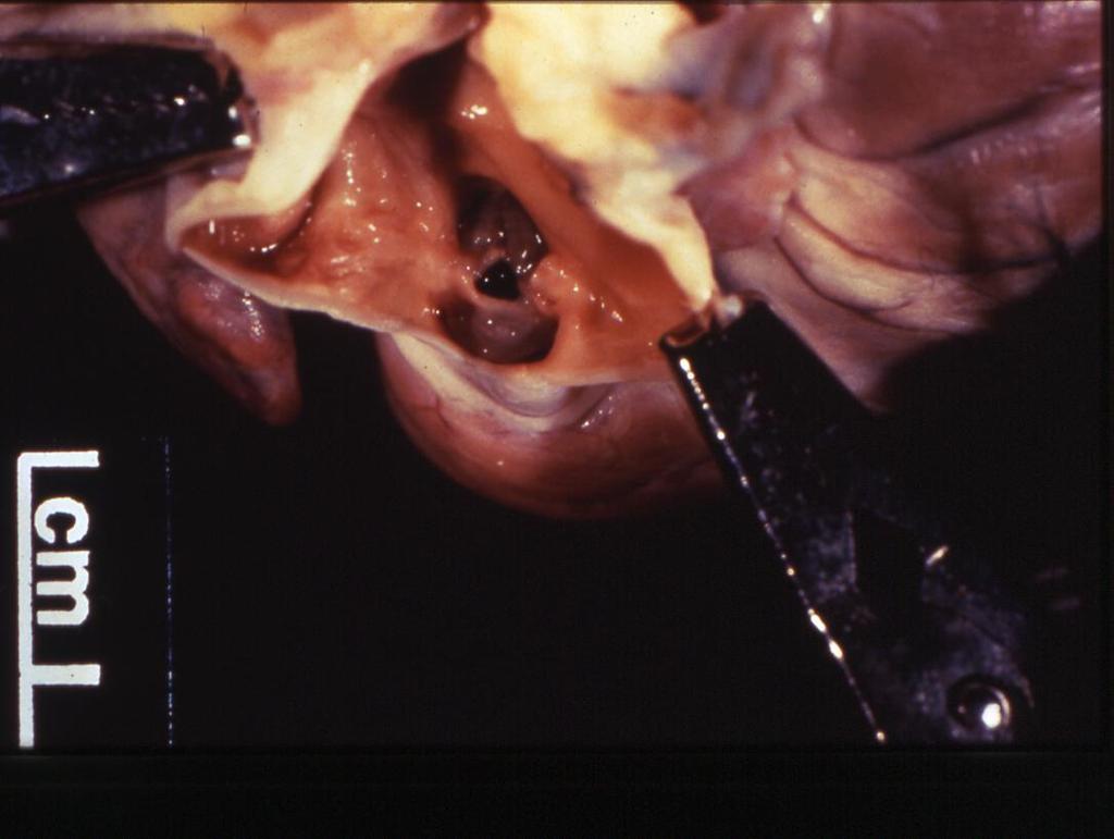 Case 3 15-week-old, female Beagle puppy with facial and submandibular edema. Jugular pulses, grade VI/VI holosystolic murmur. Cardiomegaly.