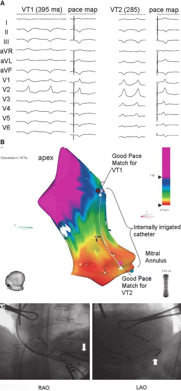 Soejima et al Subxiphoid Surgical Approach and VT 1199 Figure 2. A, Two VTs and pace mapping data are shown. Pace mapping at apical end of inferior scar produced QRS morphology similar to that of VT1.