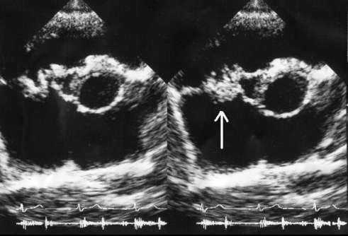 Echocardiography LVEF-45%. Moderate LV dilation with mild systolic dysfunction. MR due to prolapse. A mass in arterial side of AMVL.