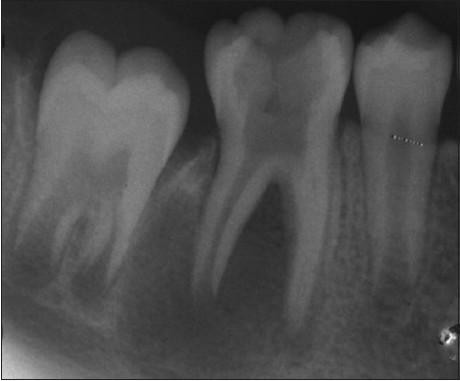 XI SOE Station Sample** STATION 2 Instructions to candidate: A 13-year male is referred to the emergency endodontic clinic with right extra-oral swelling, 2 month earlier (1 st visit), patient