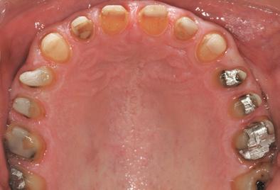 prospective restorations. Phase IV: Orthodontic Treatment Orthodontic treatment was started in order to move tooth # 27 mesially, and to intrude and retrude teeth # s 23-26.