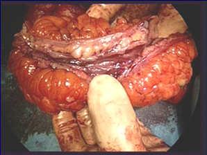 fistula, primary anastomosis Sigmoid colon spared Follow up at 6 months Patient happy Doing well