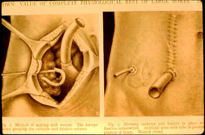 Ulcerative colitis Ileostomy and cecostomy Present Ginzburg Crohn 1982.