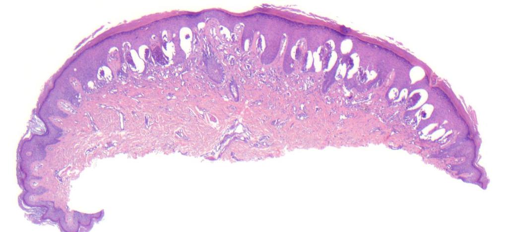 Spitz nevus, Spitzoid Melanoma and Atypical Spitz Tumors