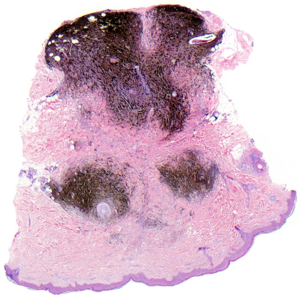 Cellular blue nevus Large tumor (>1 cm) raised papule with ill-defined border Lower back and buttocks in young adult Pandermal melanocytic proliferation with a characteristic dumb-bell