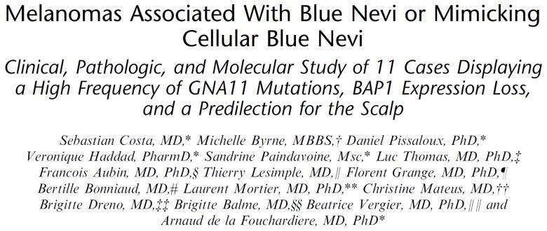 GNAQ and GNA11 mutations, loss of BAP1 and chromosomal instability in blue nevus-like melanomas Loss of nuclear BAP1 IHC GNAQ mutation (Exon 5) GNA11 mutation (Exon 5) Cellular Blue nevus Melanoma,