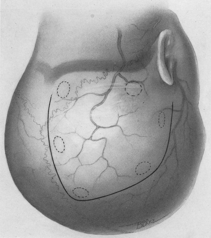 500 Guy L. Odom and Barnes Woodhall Occipital Flap In the occipital region the scalp (Fig. 5 A) and bone flaps are reflected separately.