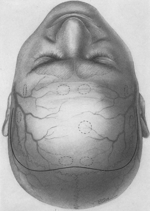 494 Guy L. Odom and Barnes Woodhall Bilateral Frontal Flap A bilateral frontal flap (Fig. ~ A), also must avoid the branches of the facial nerve on each side and should not enter the frontal sinuses.