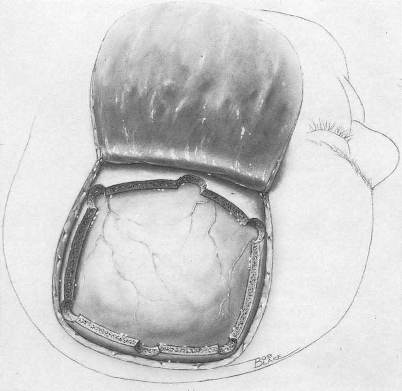 Supratentorial Skull Flaps 497 The scalp is reflected laterally and a free bone flap is removed (Fig. 3 B).