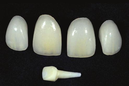 Figure 24 An incisal view shows how thin the walls of the remaining tooth structure are; a normal 1.2 mm reduction on the facial would remove the entire facial wall.