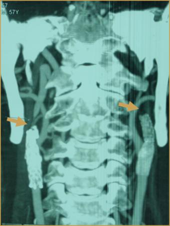 cervical vertebra: for clamping space & procedure