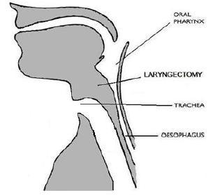 What is a laryngectomy? A laryngectomy is essentially complete surgical removal of the larynx (voice box) which disconnects the upper airway (nose and mouth) from the lungs.