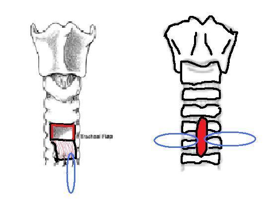 Types of surgical tracheostomy The tissues around the trachea are dissected and then the trachea is entered by making an incision in its anterior wall.