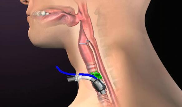 It should be noted that some designs of tracheostomy tube require the inner cannula to be in situ before the tracheostomy can be connected to an anesthetic