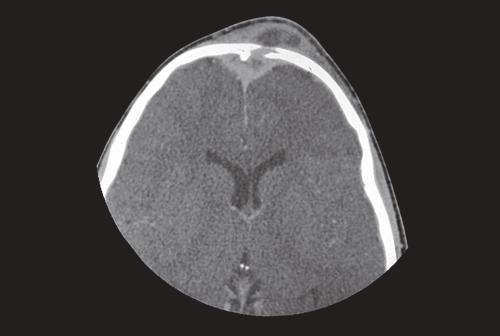 Bony complication Frontal sinusitis complicated by osteomyelitis of the frontal bone is known