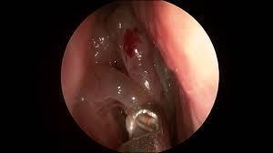 CRS) With Nasal polyps (