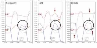 Due to the required deflation of the IABP in late diastole, it provides only a transient pressure increase early in diastole but reverses this augmentation just before systole, lowering the