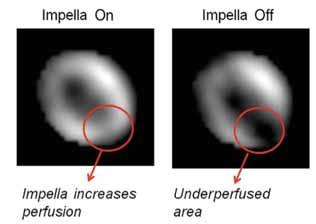 Figure 16. Improvement in myocardial perfusion with Impella support (Technetium-99m sestamibi imaging) (Reprinted with permission from Aqel RA, et al. J Nucl Cardiol. 2009).