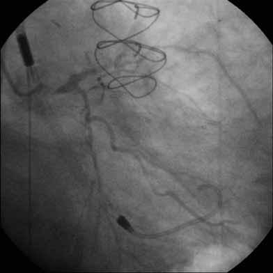 A Case of Percutaneous Coronary Intervention for Acute Myocardial Infarction Infarction cardiogenic shock supported by the Impella device.