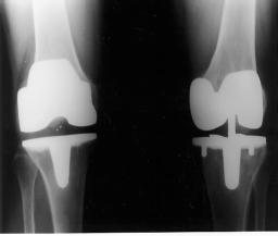 Anteroposterior view of both knees before the operation.