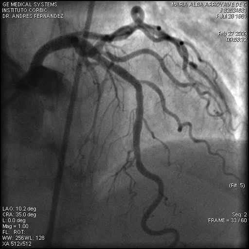 Baseline Angiogram Mid-LAD.