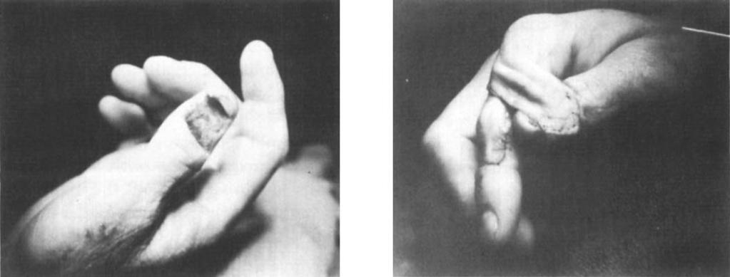 Fig 1 Fig 2 A deep grinder injury to the dorsum of the thumb caused loss of the dorsal one-third of the distal phalanx and of the nail matrix.