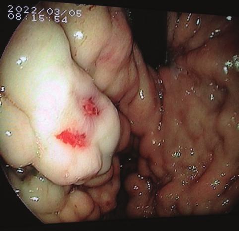 2 Case Reports in Surgery Figure 1: Upper gastrointestinal endoscopy showing extensive gastric varices. Figure 3: