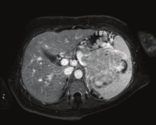 Discussion Figure 2: Magnetic resonance imaging of the abdomen was performedwhichrevealeda9 7 8 cm mass infiltrating the pancreatic tail and spleen along with massive upper abdominal varix formation