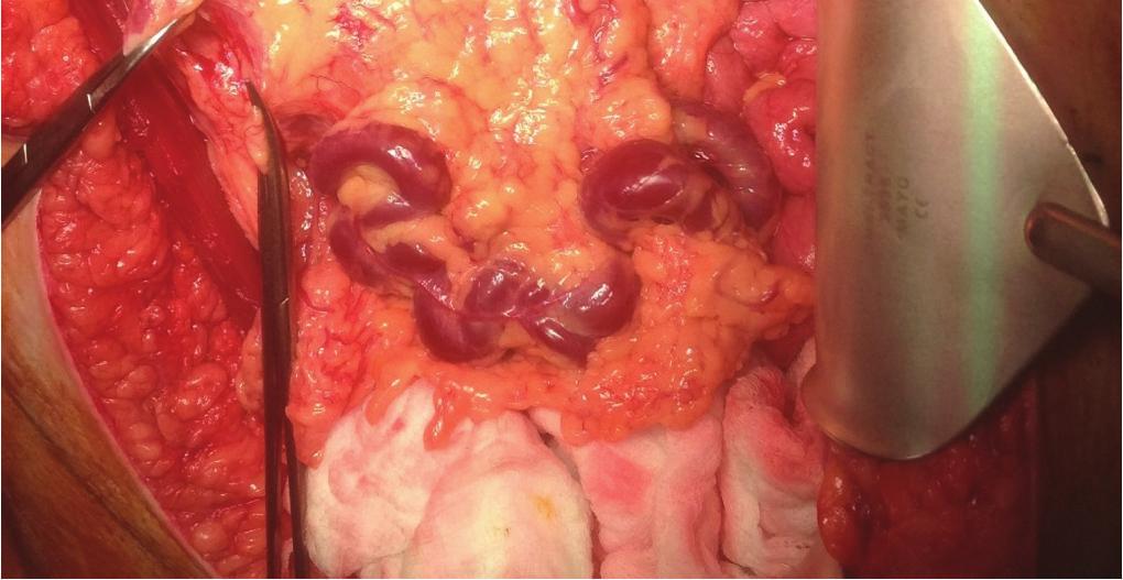 She was given corticosteroids for 4 days and then underwent initial uncomplicated caesarean section followed by a radical en bloc partial pancreatectomy and splenectomy with resection of the