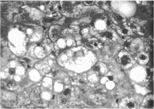 neutrophils macrovesicular steatosis