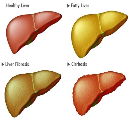NAFLD Pathologic Spectrum NAFL (nonalcoholic fatty liver) Excess fat accumulation (steatosis) NASH (nonalcoholic steatohepatitis) Defines a