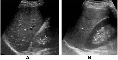 Steatosis: Ultrasound Normal Liver: Echogenecity similar to R-Kidney cortex Fatty Liver: Liver