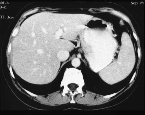 Steatosis: CT Scan Normal