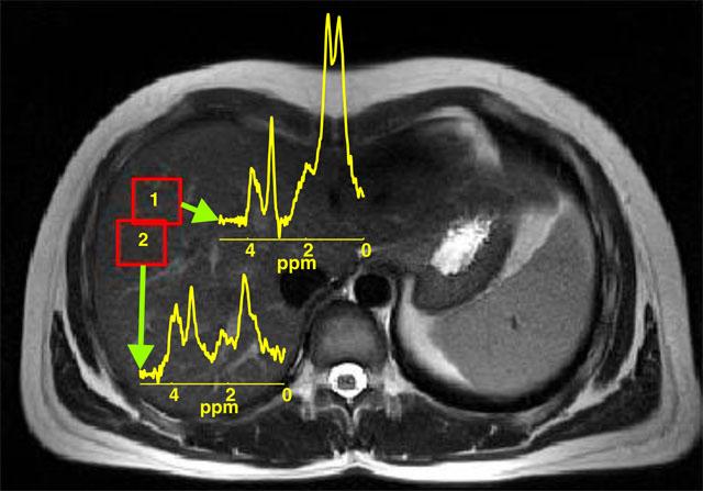 Steatosis: MRI Techniques MRS: Spectroscopy (best) Fat Quant signal Accurate/ Reproducible Limitations: