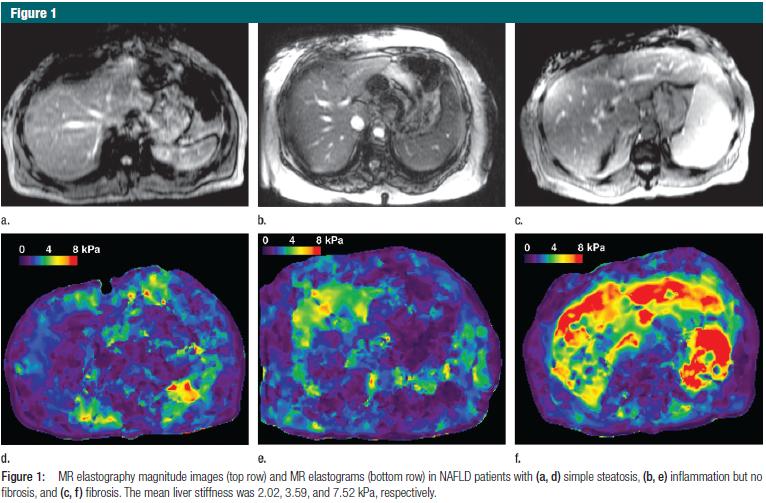 MR Elastography Reliable Higher success rates Higher Sn/ Sp: 86%/ 85% Identifies