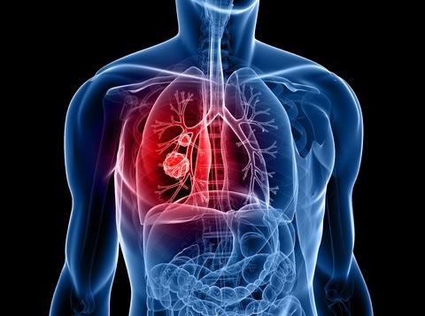 2 IHC Biomarker Testing Lung cancer is the leading cause of death Lung cancer is the most prevalent form of cancer in the world. Each year, more than 1.8 million new cases are diagnosed.