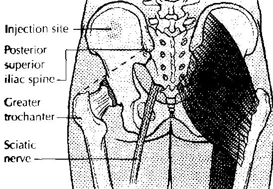 Dorsogluteal Inject above and outside a line drawn from the posterior superior iliac spine to the greater trochanter of the femur.